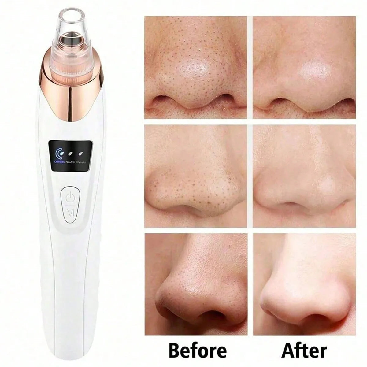 Electric Blackhead Remover – Pore Vacuum & Acne Suction Cleaner