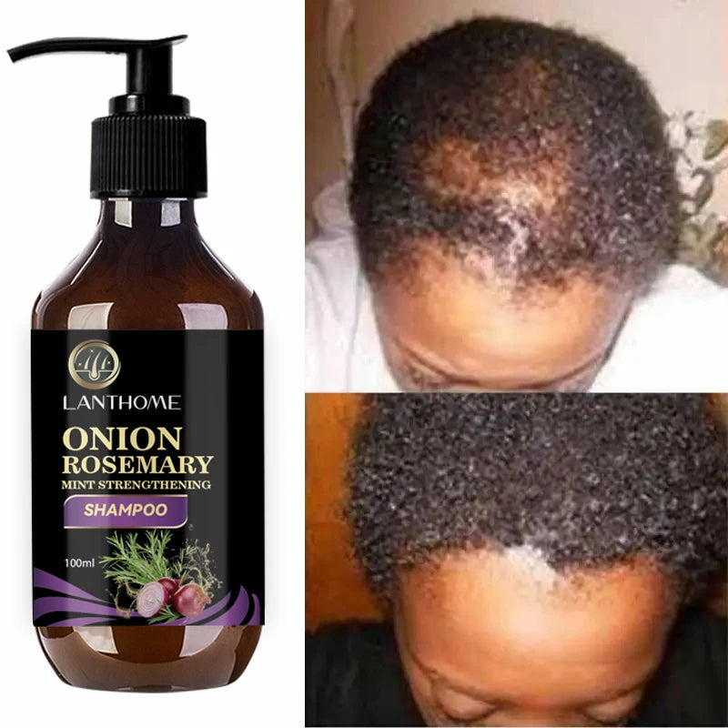 Onion & Rosemary Hair Regrowth riazexpress