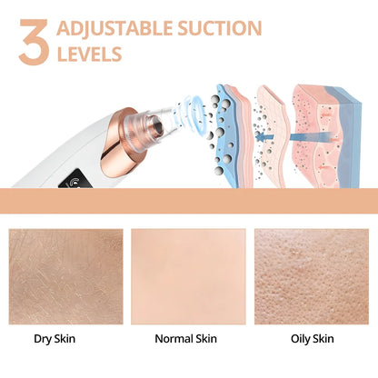 Blackhead Remover Vacuum - Facial Pore Cleaner with 5 Attachments, Electric USB Pore Vacuum